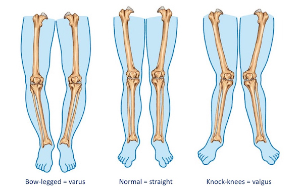 Knee misalignment clearance